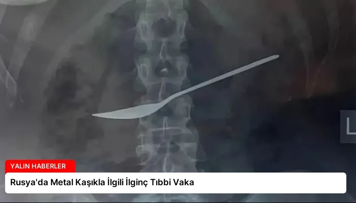 Rusya’da Metal Kaşıkla İlgili İlginç Tıbbi Vaka